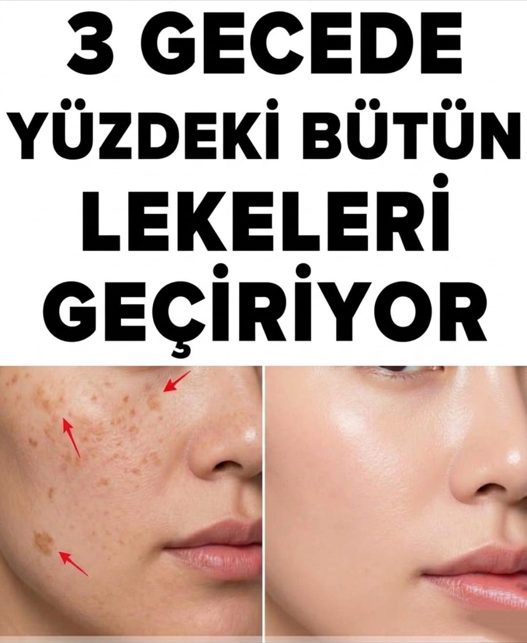 3 Gecede Yüzdeki Lekeler Geçer mi?